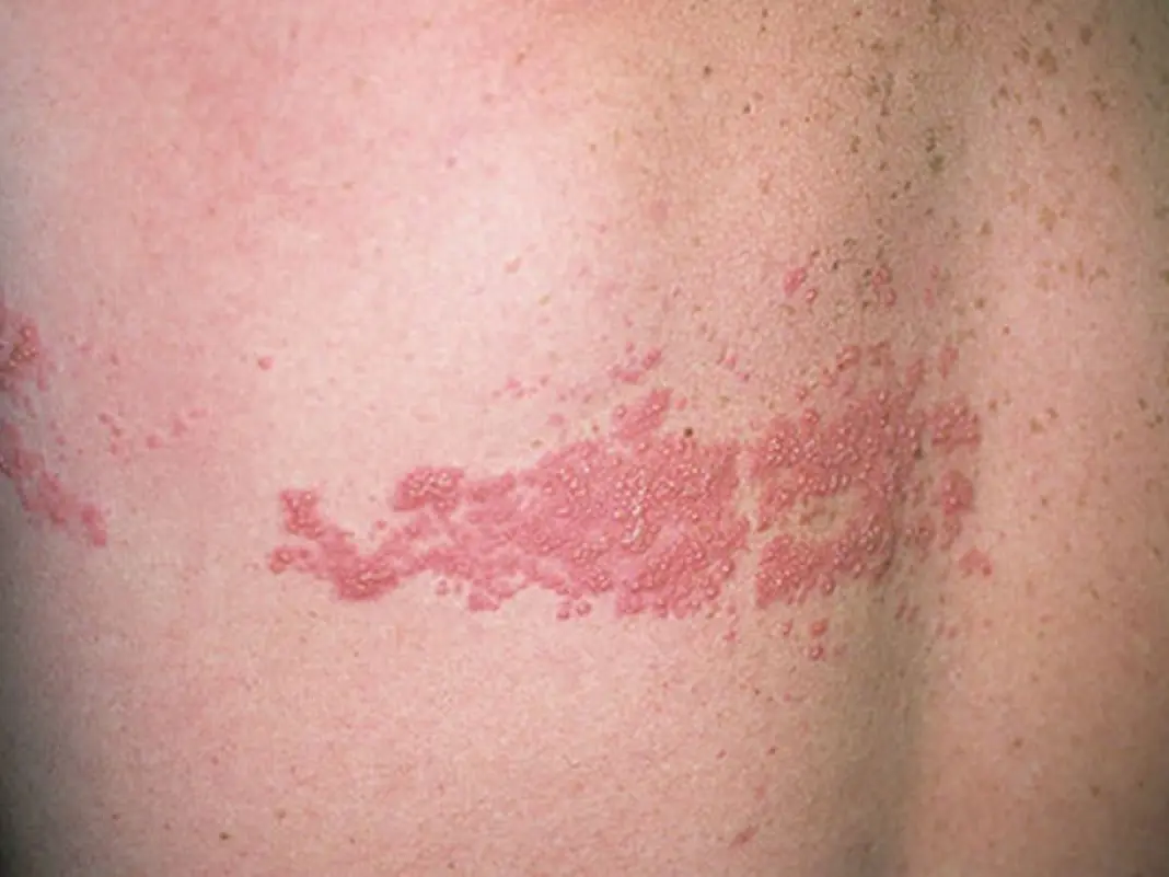 الحزام الناري: ألم مستمر ورحلة مقاومة للجهاز العصبي