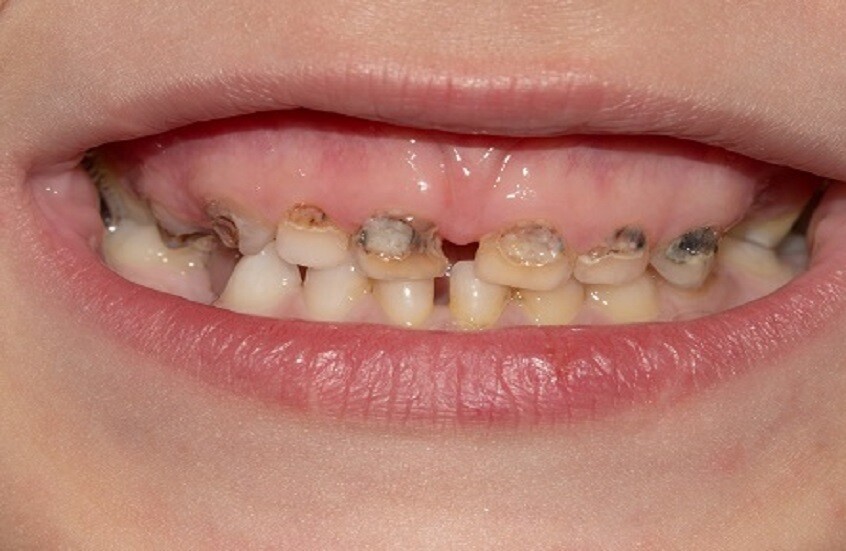 التدخين السلبي يضاعف تسوس الأسنان لدى الأطفال