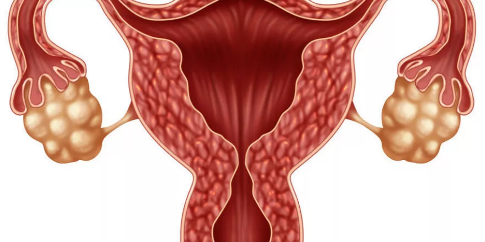 كشف علمي جديد: متلازمة تكيس المبايض لا تخص النساء فقط