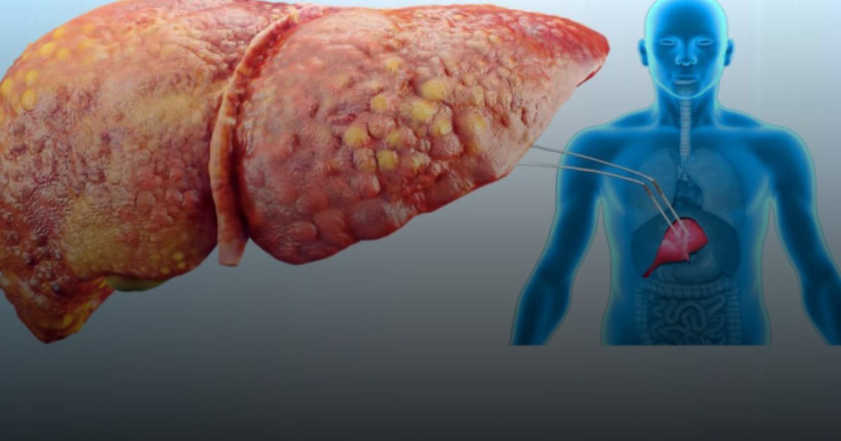 حالة نادرة مضاعفاتها خطيرة.. أعراض الكبد الدهني في الحمل وطرق العلاج