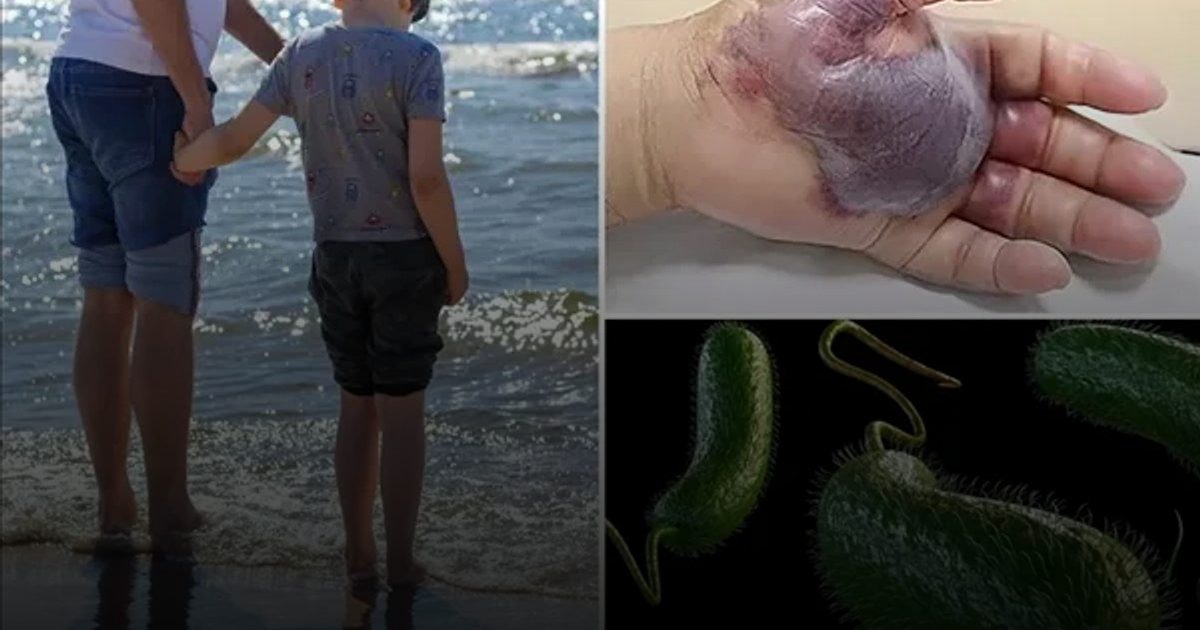 وفاة 4 أشخاص في فلوريدا بسبب "البكتيريا الآكلة للحوم"