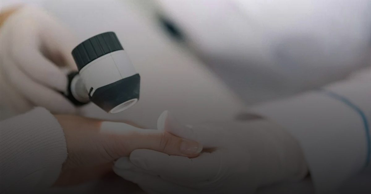 اختبار منزلي يكشف سرطان الجلد