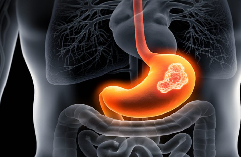 سرطان المعدة: الأعراض الصامتة قد تكون إنذارات خفية