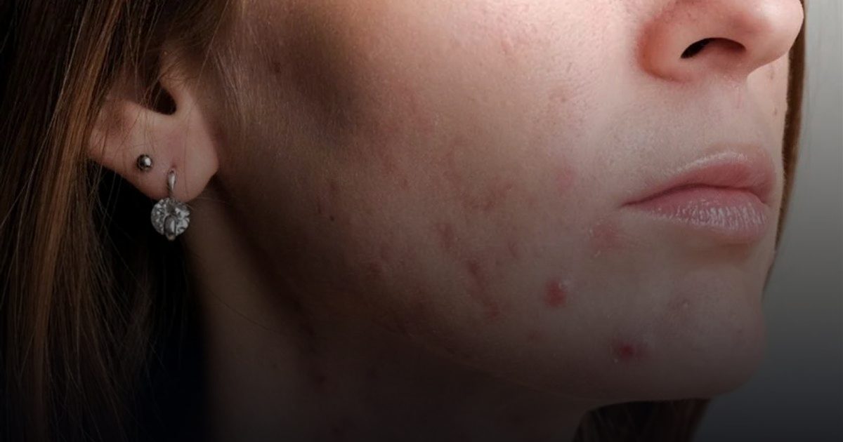 حب الشباب يضاعف اضطرابات الطعام في هذه المرحلة