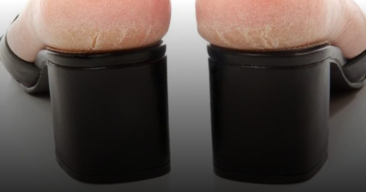 هذه أسباب تشقق القدمين وتلك طرق العلاج