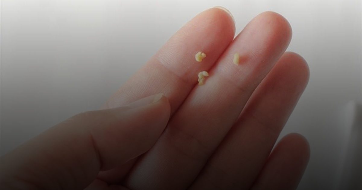 حصوات اللوزتين.. سبب رئيسي وراء الرائحة الكريهة للفم