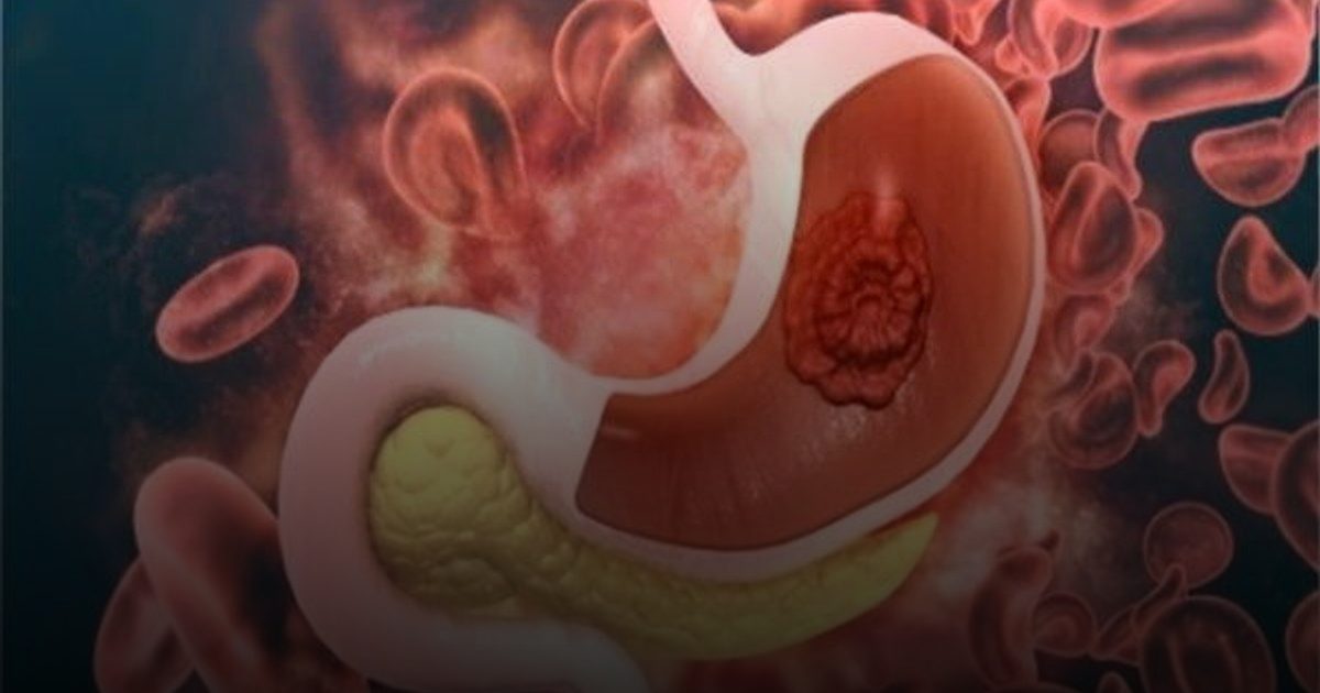 التهاب المعدة وحقيقة علاقته بالسرطان