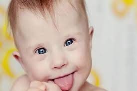 تقنية جينية حديثة تُعطِّل الكروموسوم المُسبب لمتلازمة داون