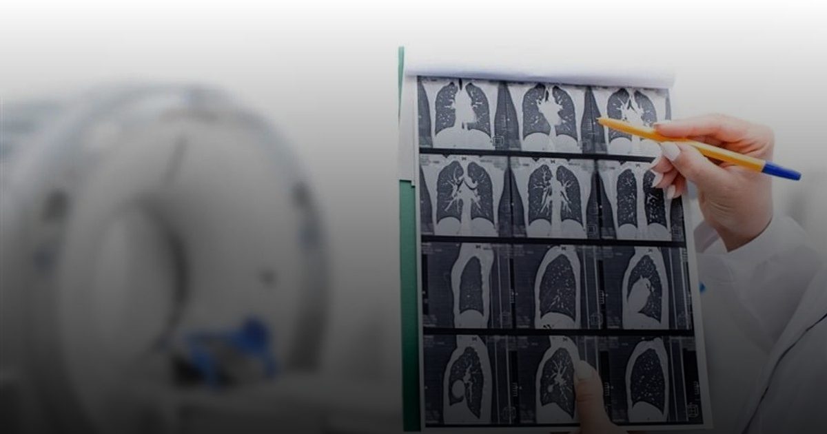 دراسة: توسيع فحص سرطان الرئة يضاعف الوفيات المتجنَّبة 3 مرات بين المدخنين