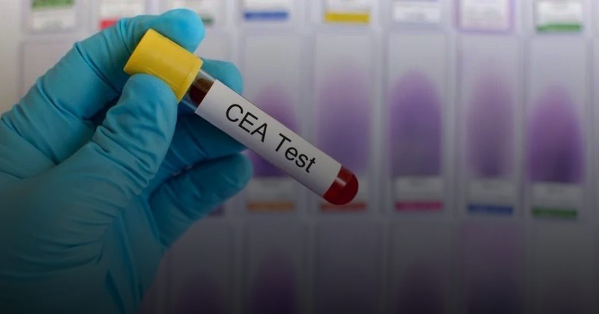 اختبار دم يكشف عن بداية انتكاسة لدى المصابات بسرطان الثدي