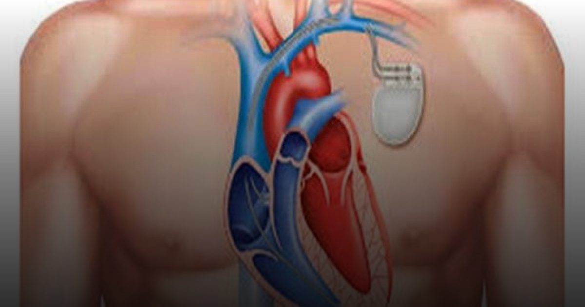 نجاح زراعة منظم دائم لضربات القلب لإنهاء معاناة مريض من اضطراب كهربي خطير