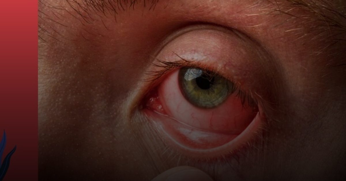 ​الصحة تحذر: الغبار يسبب حساسية الأنف والتهاب الملتحمة الجرثومي