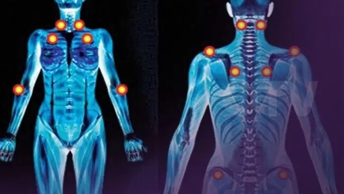 جهاز تحفيز الأعصاب يقدم أملًا جديدًا لمرضى الفيبروميالجيا