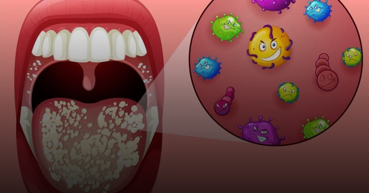 بكتيريا الفم من أسباب الإصابة بـ"الصداع النصفي"..