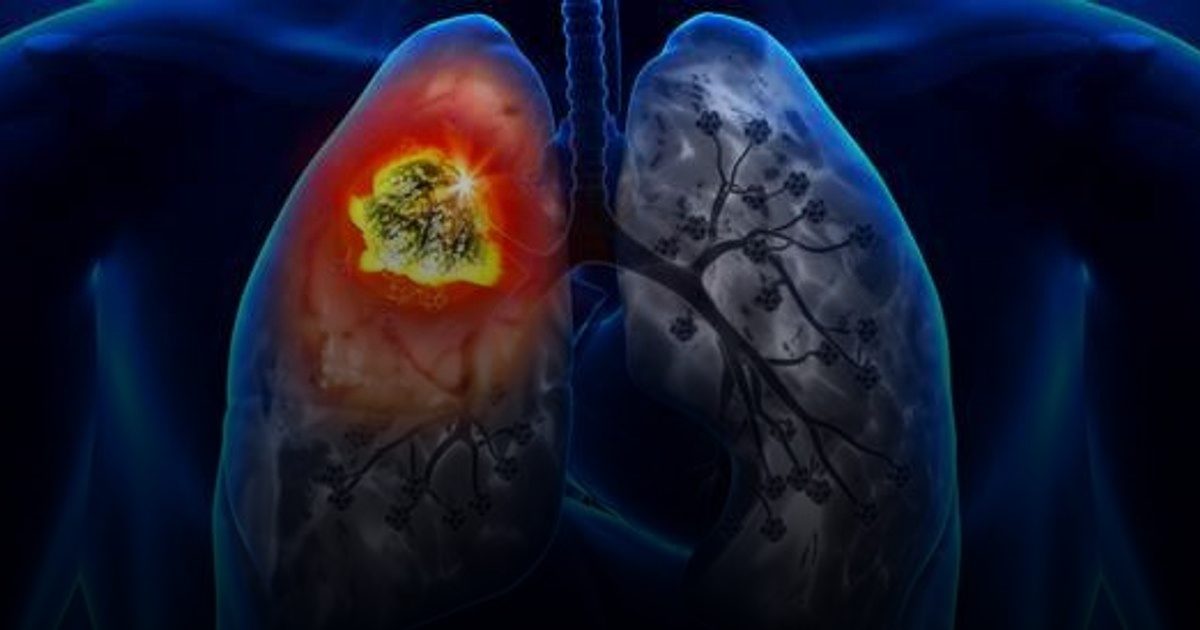 سرطان الرئة واحد من أكثر عشرة أورام سرطانية انتشاراً في المجتمع السعودي