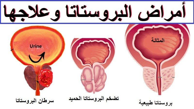 كيف تخفف من أعراض تضخم البروستاتا بأبسط الطرق؟