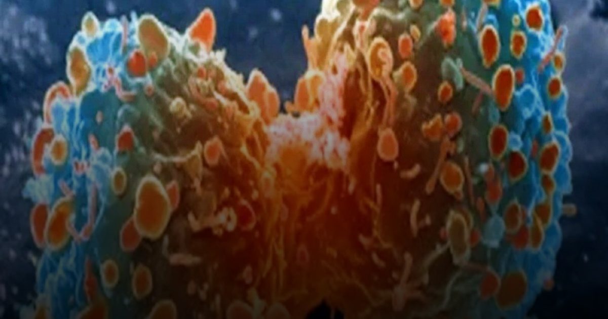 آلية جديدة تعيد الأمل لمرضى  سرطان البنكرياس