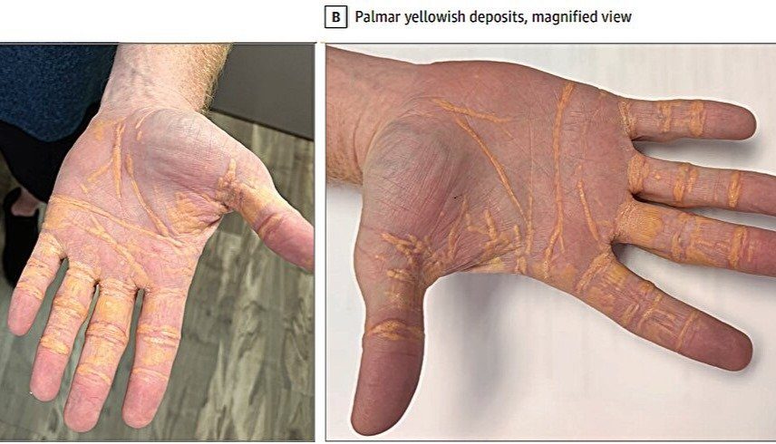 بسبب  الإفراط في تناول اللحوم ..عقد صفراء غريبة على جسم رجل