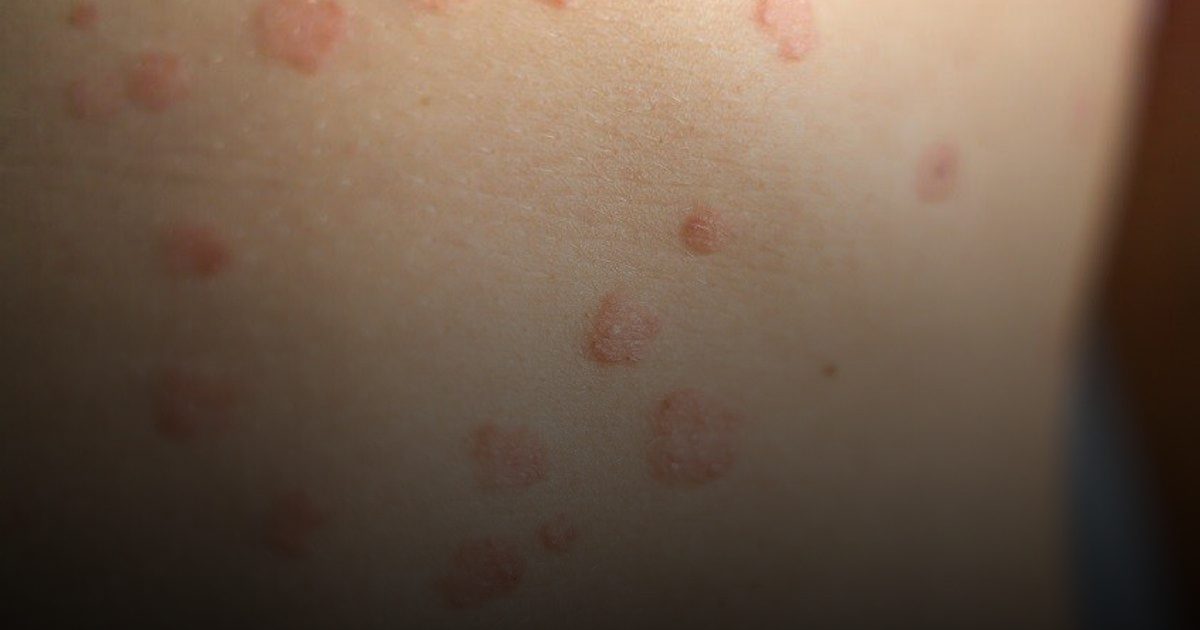 دراسة سويدية تكشف صلة حيوية بين الصدفية واضطرابات الأمعاء