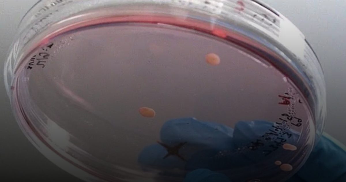 إنجاز علمي واعد في متلازمة داون.. حذف الكروموسوم الزائد يثير الأمل والتحديات