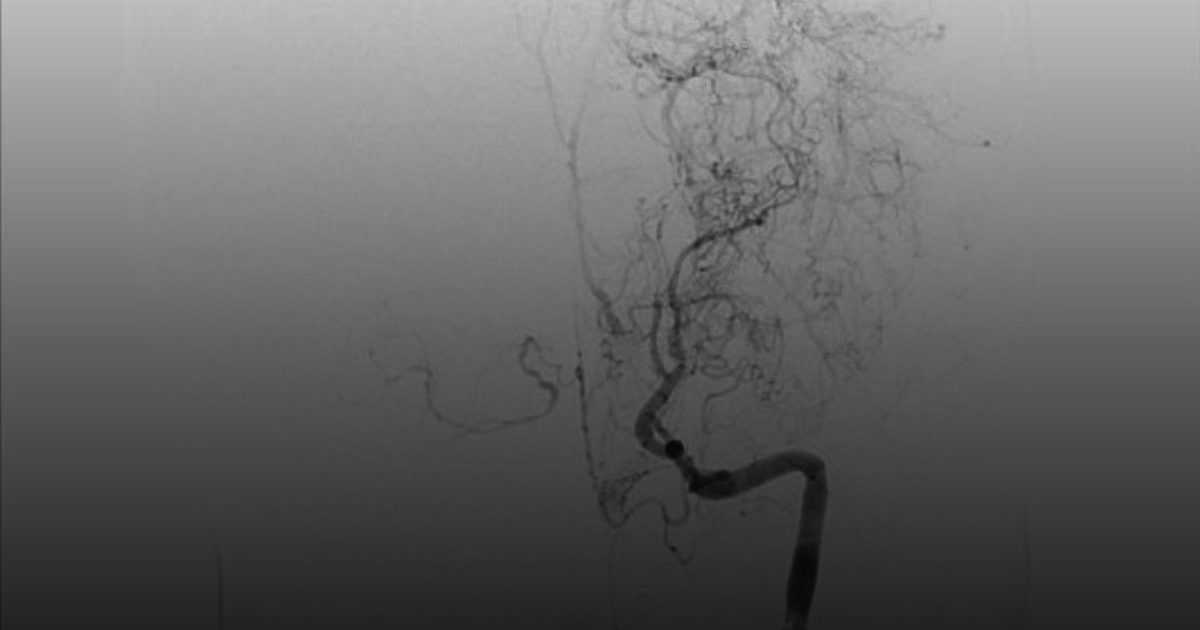 بجراحة دقيقة ..“سعود الطبية” تعالج  طفلاً من جلطات دماغية