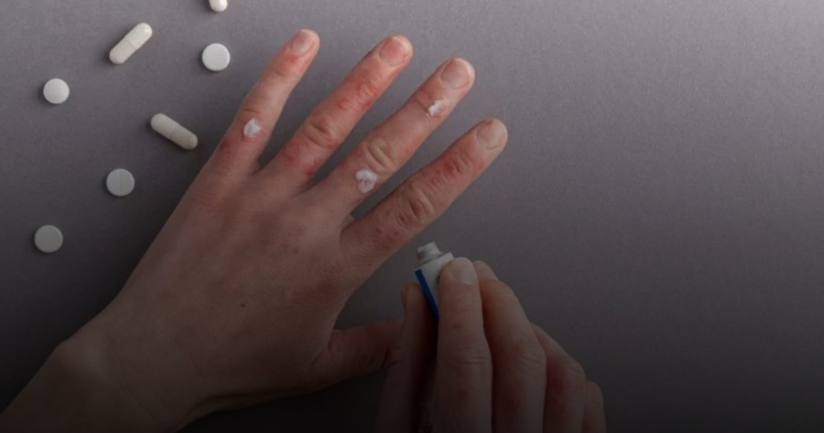 " أنزوبغو "  دواء جديد يعالج الإكزيما