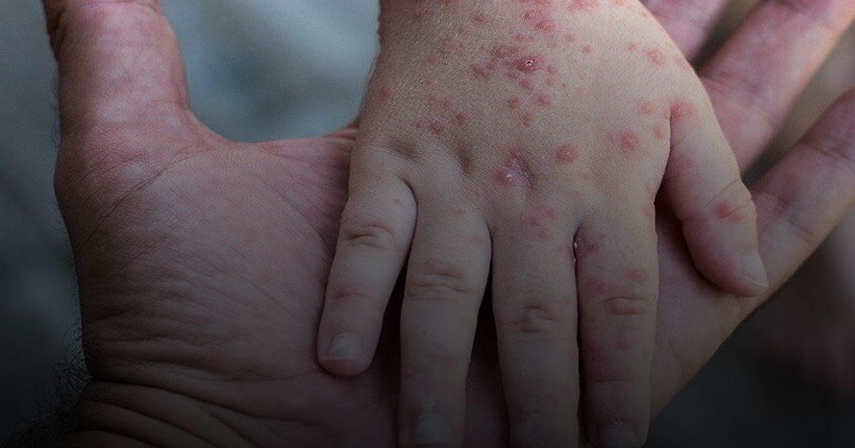 فيروس "كوكساكي".. لماذا يمنع الأطباء استخدام المضادات الحيوية في علاجه؟