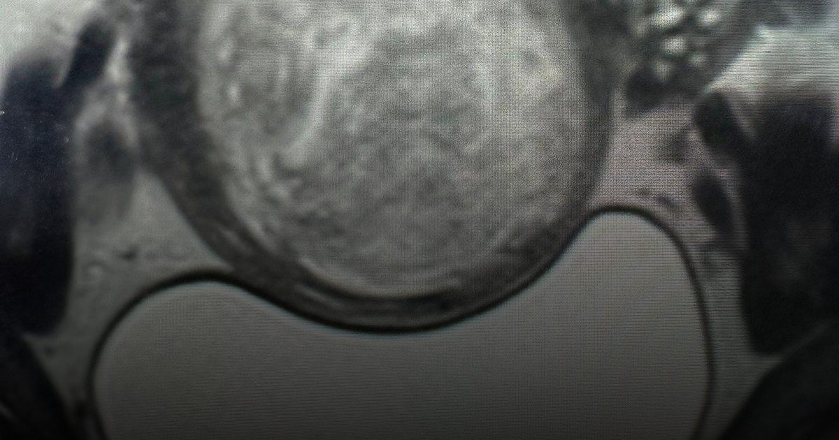 في إنجاز طبي .. مدينة الملك سعود الطبية تعالج ألياف الرحم بالقسطرة