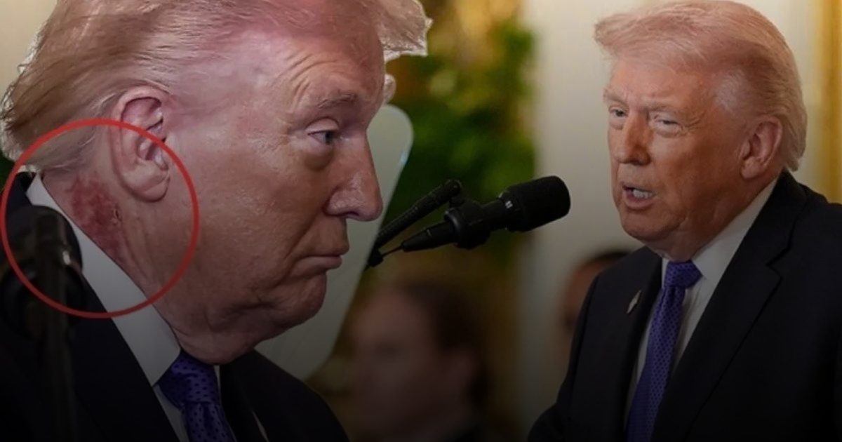 بقع حمراء برأس ترامب تثير تساؤلات صحية