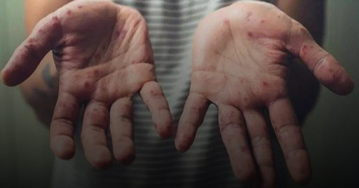 تايلاند تسجّل 40 إصابة بجدري القرود