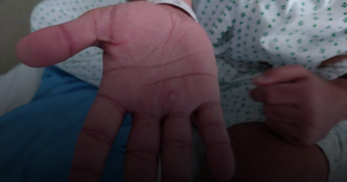 «الصحة العالمية» : جميع سلالات «جدري القرود» منتشرة في  العديد من دول العالم