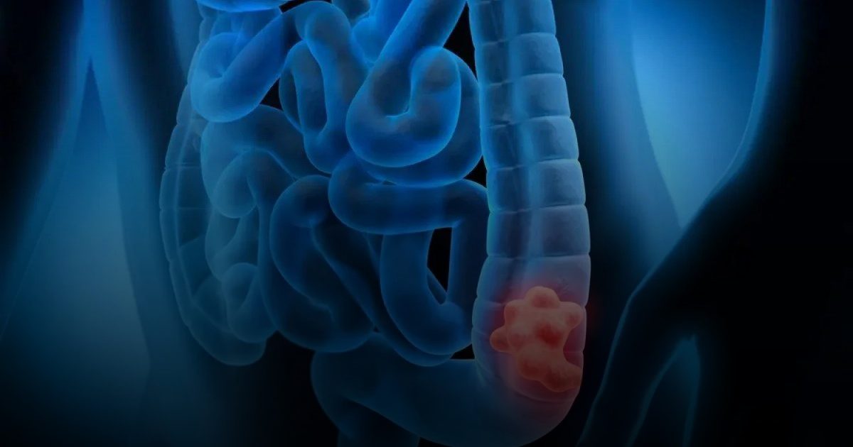 اكتشاف الآلية الجزيئية لصلة بكتيريا الأمعاء بسرطان القولون