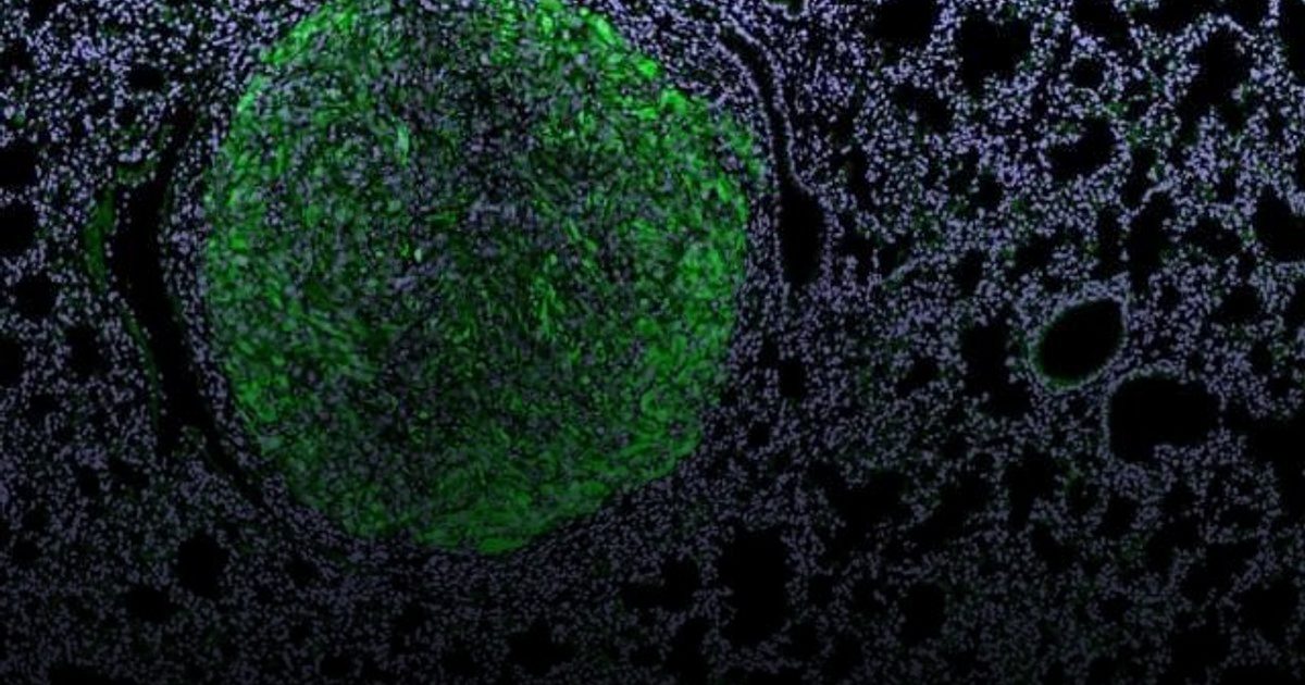 ابتكار مناعي جديد يمنح أملاً لمرضى سرطان الكلى