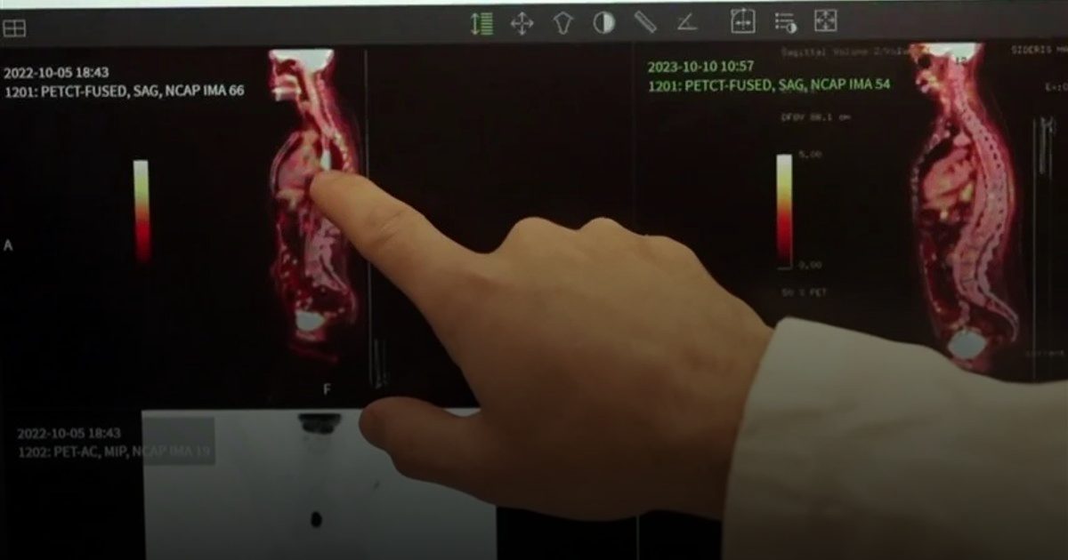 علاج جديد لتفتيت الخلايا السرطانية بالأشعة تحت الحمراء