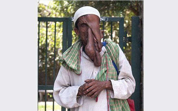   متلازمة بروتيوس و الرجل الفيل واليد الغريبة وعلاقتها بالعلم