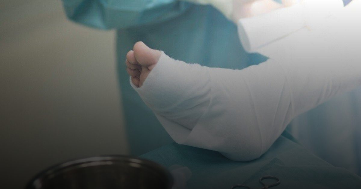 جراحة روسية لدمج الأطراف الاصطناعية مباشرة في النسيج العظمي