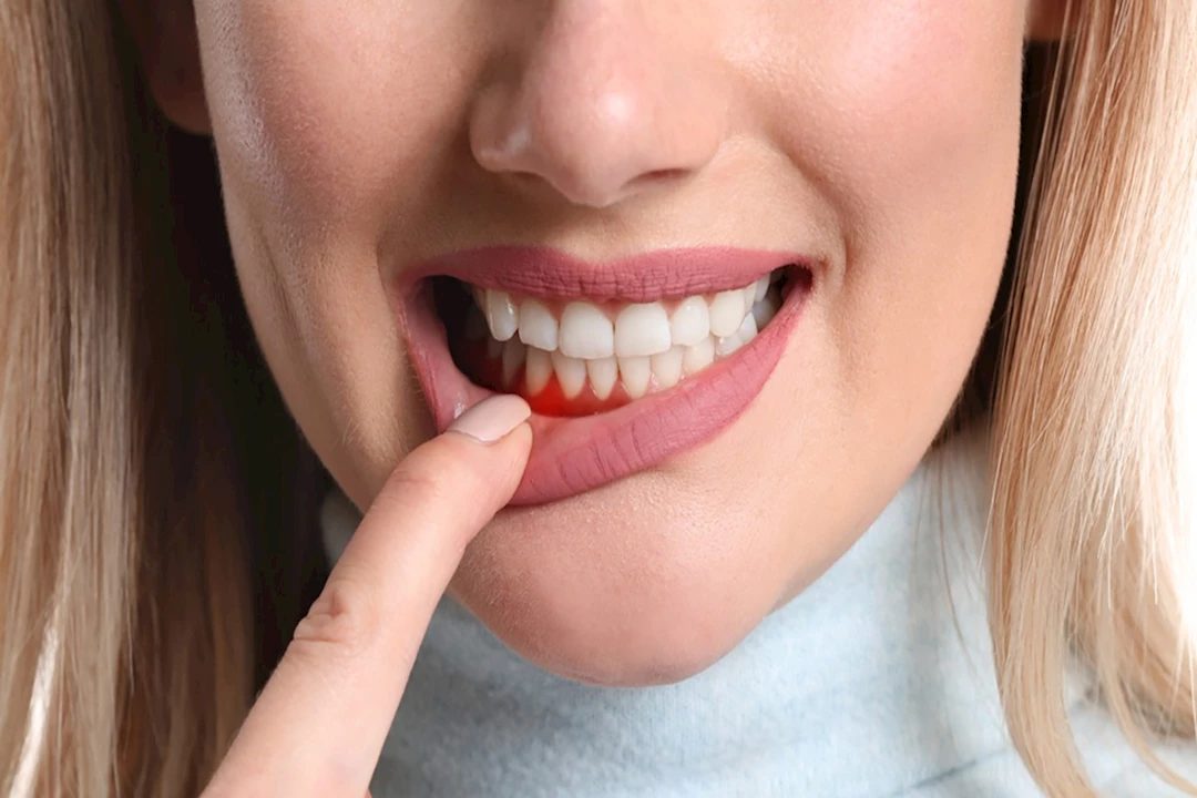 دراسة تربط أمراض اللثة ومرضى الكلى بآليات الالتهاب