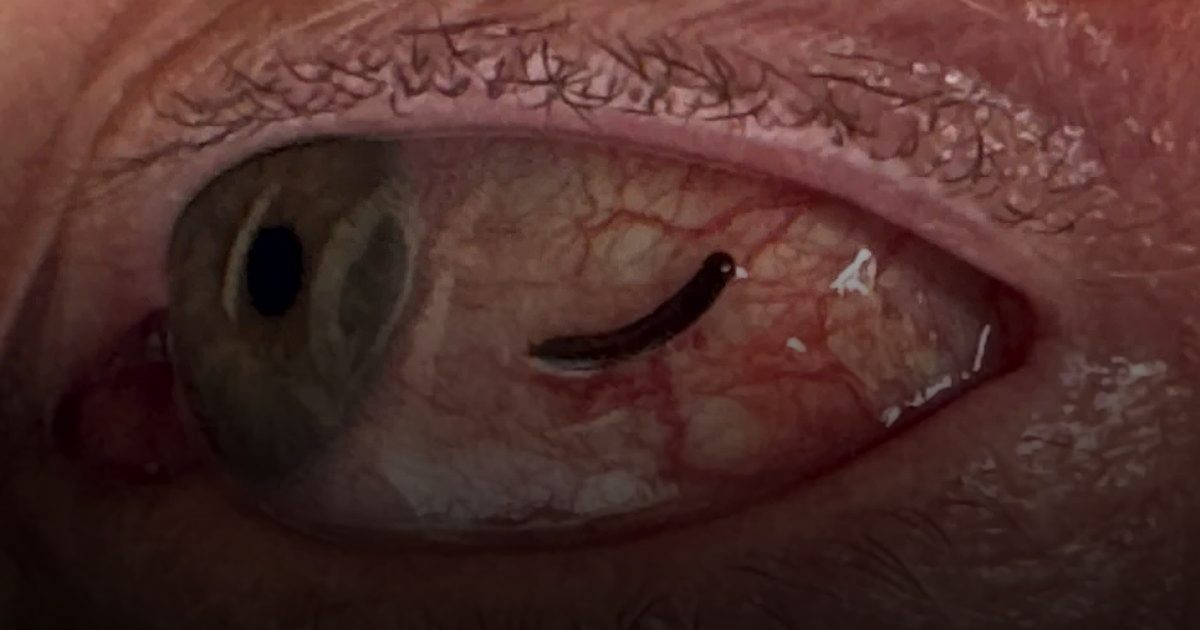 دودة تتسلل إلى عين بريطاني وتتغذى على دمه