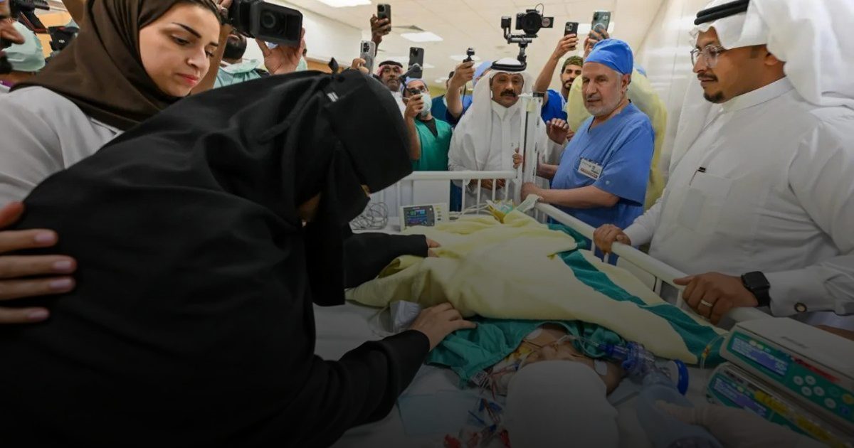 فصل التوأم الملتصق "يارا ولارا" بنجاح بعد 12.5 ساعة من الجراحة