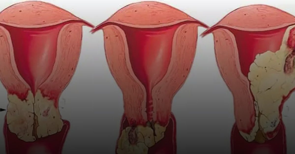 كيف يحمي فحص "مسحة الرحم" النساء من خطر السرطان؟