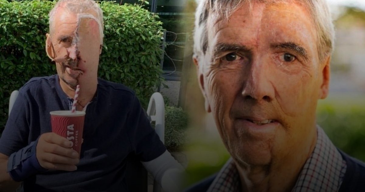 تقنية طبية مُبتكرة: بريطاني يحصل على أول وجه صناعي مطبوع بتقنية 3D بعد حادث مروع