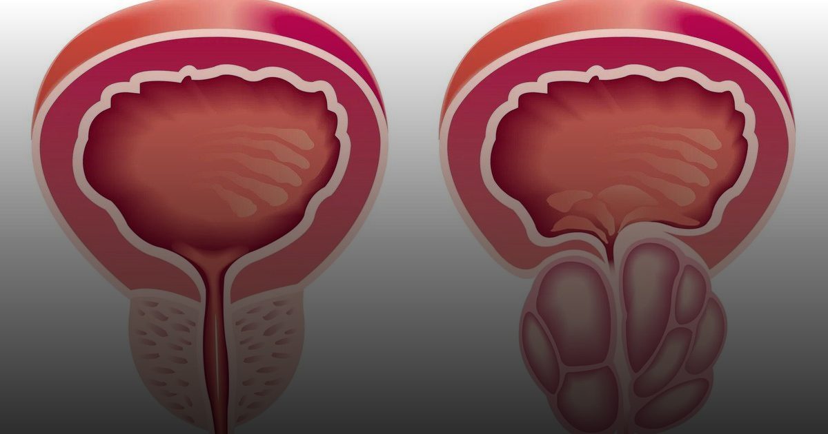 في بريطانيا.. تقنية الذكاء الاصطناعي تشخص سرطان البروستاتا في اليوم نفسه