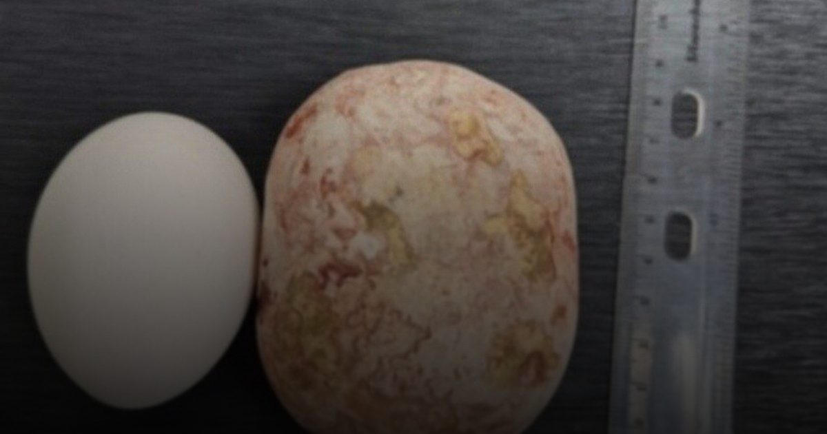 أطباء روس يستخرجون حصوة "عملاقة" تزن كيلوغراماً من مثانة رجل