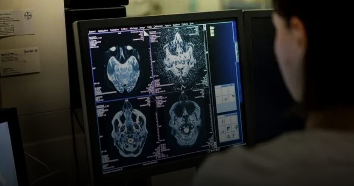 لغز المرض الغامض بالدماغ في كندا.. العلم ينفي والقلق يتصاعد