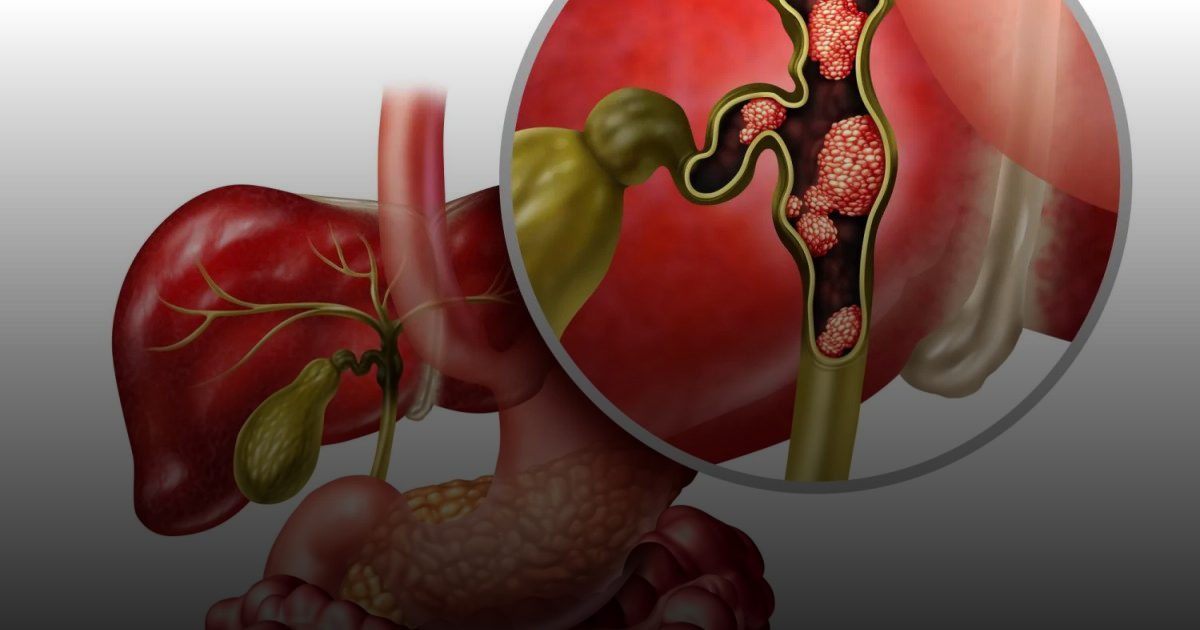 استراتيجية جديدة: دواء يستهدف بروتين "CNNM4" لعلاج سرطان الكبد العدواني