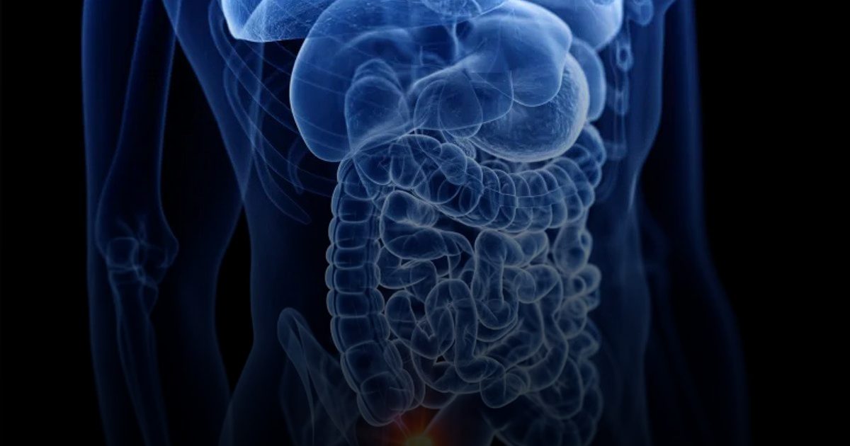 تضاعف حالات سرطان الزائدة الدودية 4 مرات في الولايات المتحدة