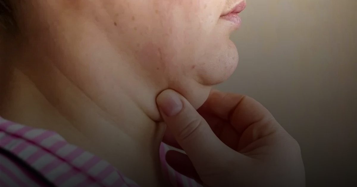 "الذقن المزدوج" حالة تتطلب التدخل الجراحي