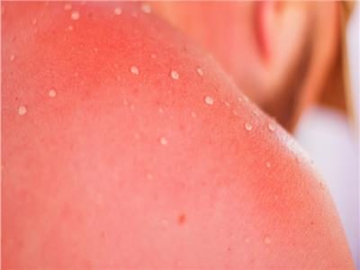 احذر حروق الشمس: 8 نصائح ذهبية لعلاج فعّال وسريع
