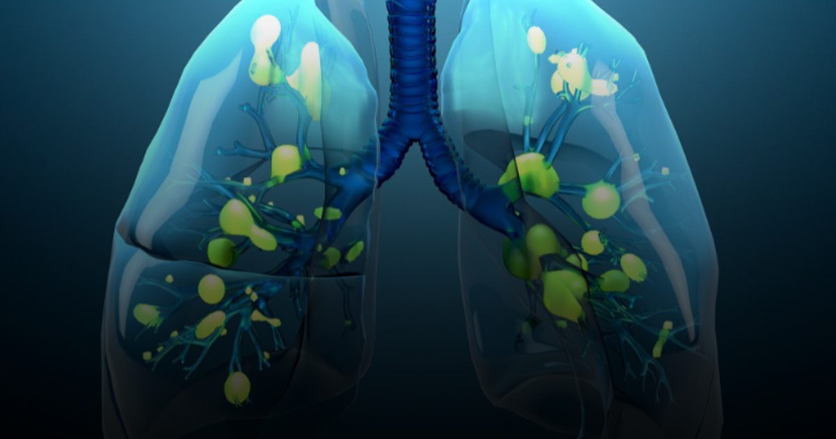 تحذير: الإنفلونزا وكوفيد والحزام الناري يرفعون مخاطر أمراض القلب والسكتة الدماغية لسنوات
