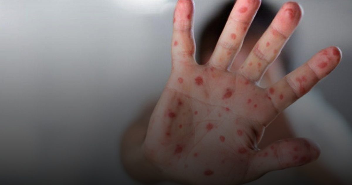 مكاسب ربع قرن تحت الاختبار: جهود التطعيم تنقذ 59 مليون إنسان من خطر الحصبة